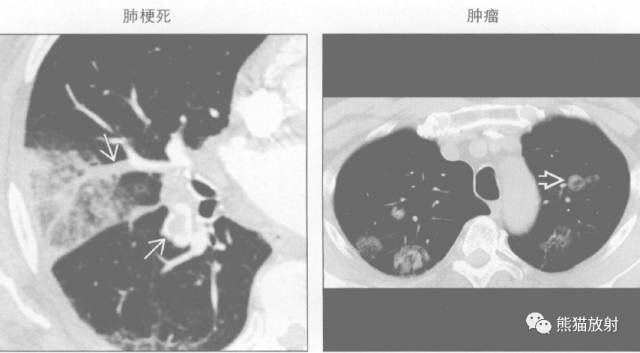 “晕征、反晕征”的鉴别诊断