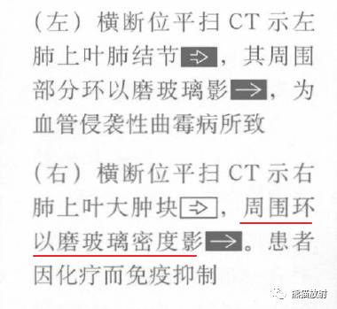 “晕征、反晕征”的鉴别诊断