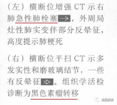 “晕征、反晕征”的鉴别诊断