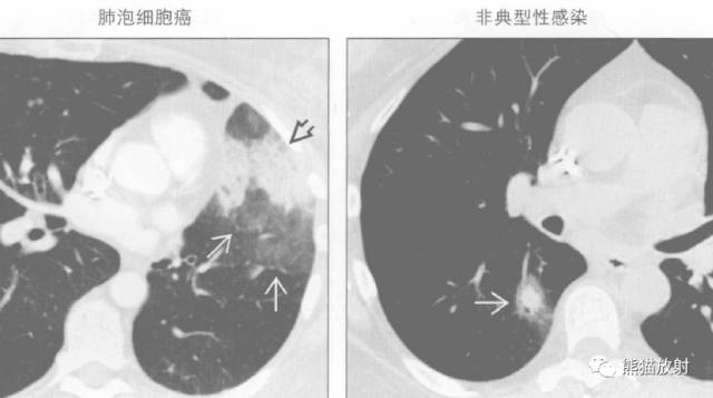 “晕征、反晕征”的鉴别诊断