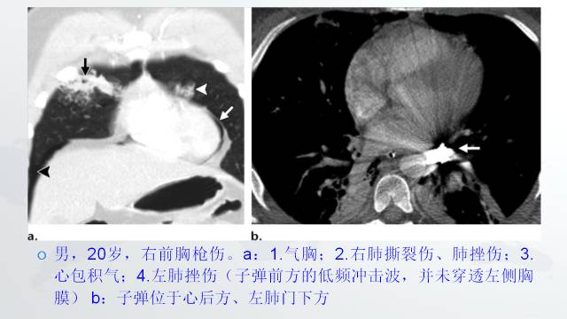 【PPT】穿透性经纵隔损伤的影像学评估 【PPT】穿透性经纵隔损伤的影像学评估