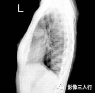 “卵壳状钙化征” 的影像表现与临床意义