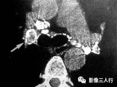 “卵壳状钙化征” 的影像表现与临床意义