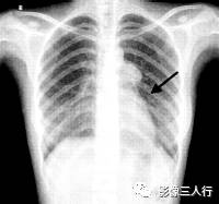 “卵壳状钙化征” 的影像表现与临床意义