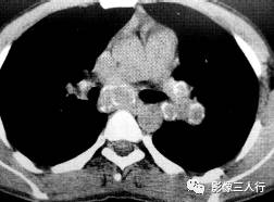 “卵壳状钙化征” 的影像表现与临床意义