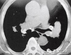 “卵壳状钙化征” 的影像表现与临床意义