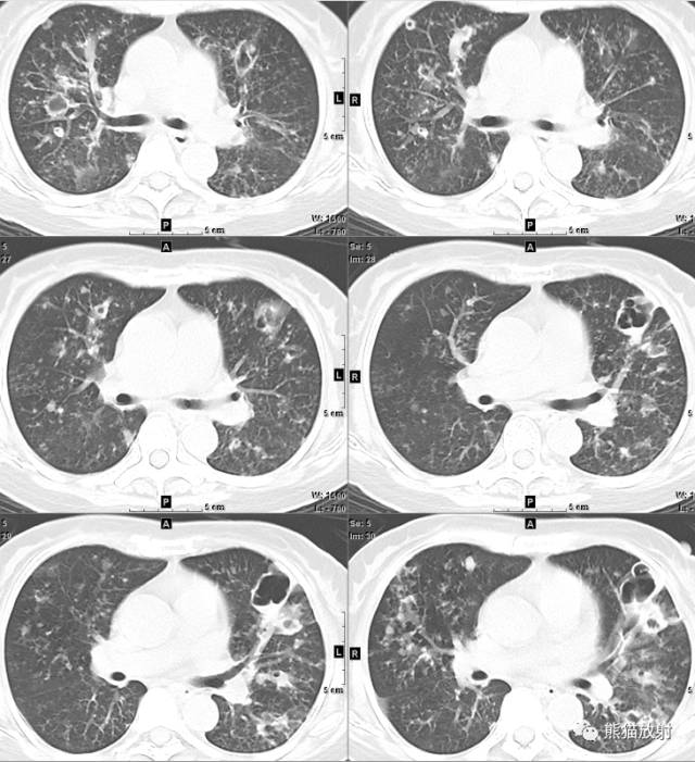 【病例】空洞为主要表现的肺真菌病7例CT影像征象
