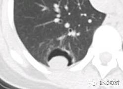 【病例】空洞为主要表现的肺真菌病7例CT影像征象