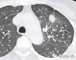 “锯齿征” 的影像表现与临床意义