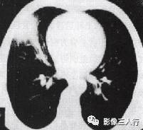 “锯齿征” 的影像表现与临床意义