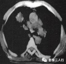 “锯齿征” 的影像表现与临床意义