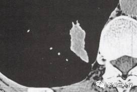 “锯齿征” 的影像表现与临床意义