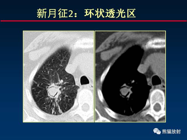 【PPT】肺曲霉菌病：放射科医生如何应对