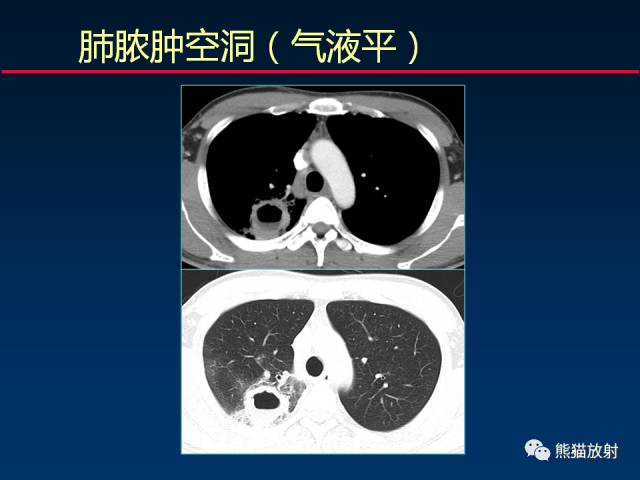 【PPT】肺曲霉菌病：放射科医生如何应对