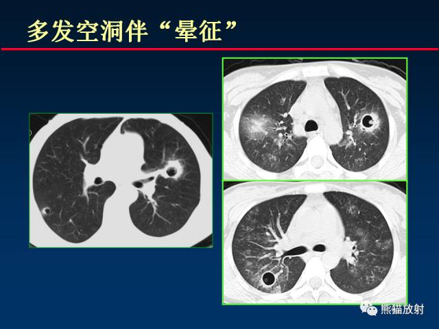 【PPT】肺曲霉菌病：放射科医生如何应对