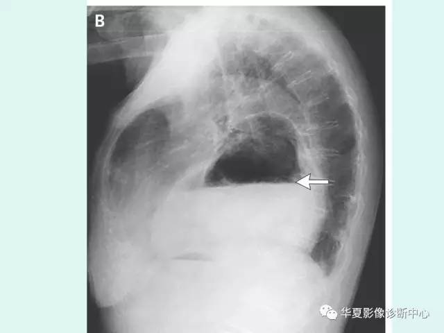 【病例】食道裂孔疝1例影像表现