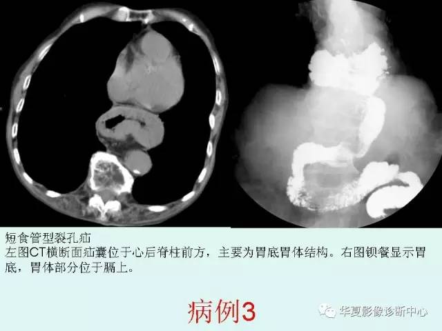 【病例】食道裂孔疝1例影像表现