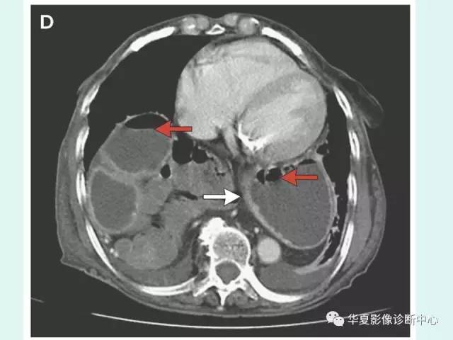 【病例】食道裂孔疝1例影像表现