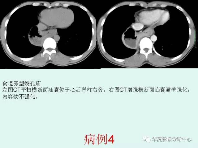 【病例】食道裂孔疝1例影像表现