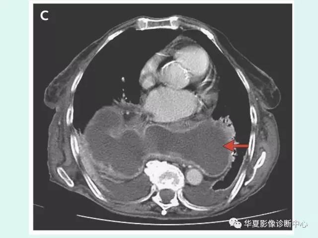 【病例】食道裂孔疝1例影像表现