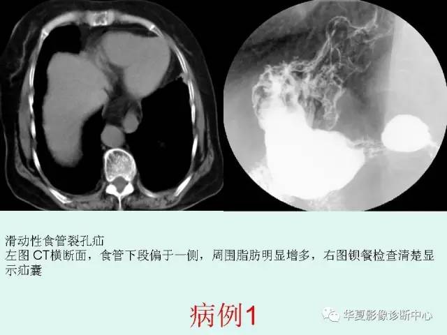 【病例】食道裂孔疝1例影像表现