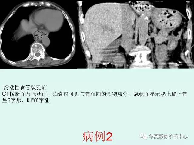 【病例】食道裂孔疝1例影像表现