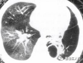 “空气潴留征” 的影像表现与临床意义