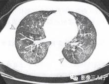“空气潴留征” 的影像表现与临床意义