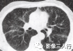 “空气潴留征” 的影像表现与临床意义