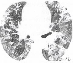 “空气潴留征” 的影像表现与临床意义