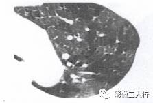 “空气潴留征” 的影像表现与临床意义