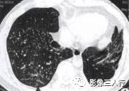“空气潴留征” 的影像表现与临床意义