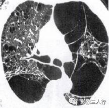 “空气潴留征” 的影像表现与临床意义