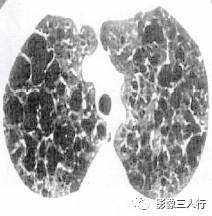 “空气潴留征” 的影像表现与临床意义