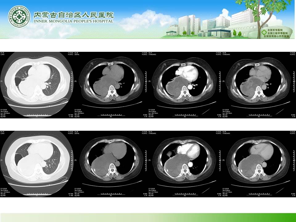 【病例】胸膜恶性孤立性纤维瘤1例X线CT