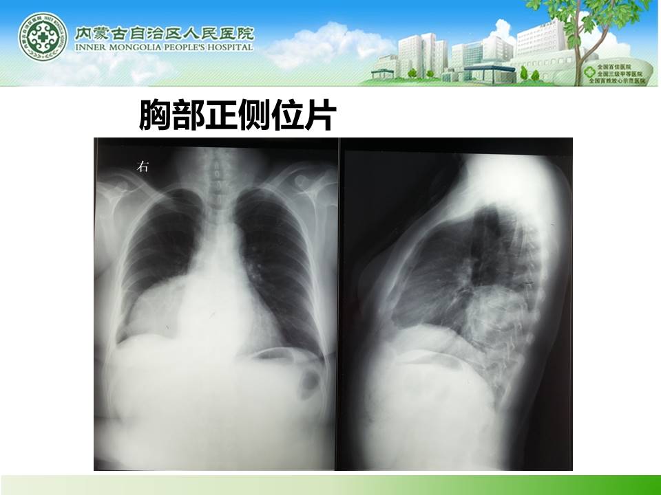 【病例】胸膜恶性孤立性纤维瘤1例X线CT