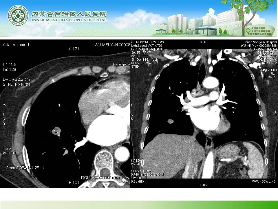 【病例】右肺下叶硬化性血管瘤1例CT