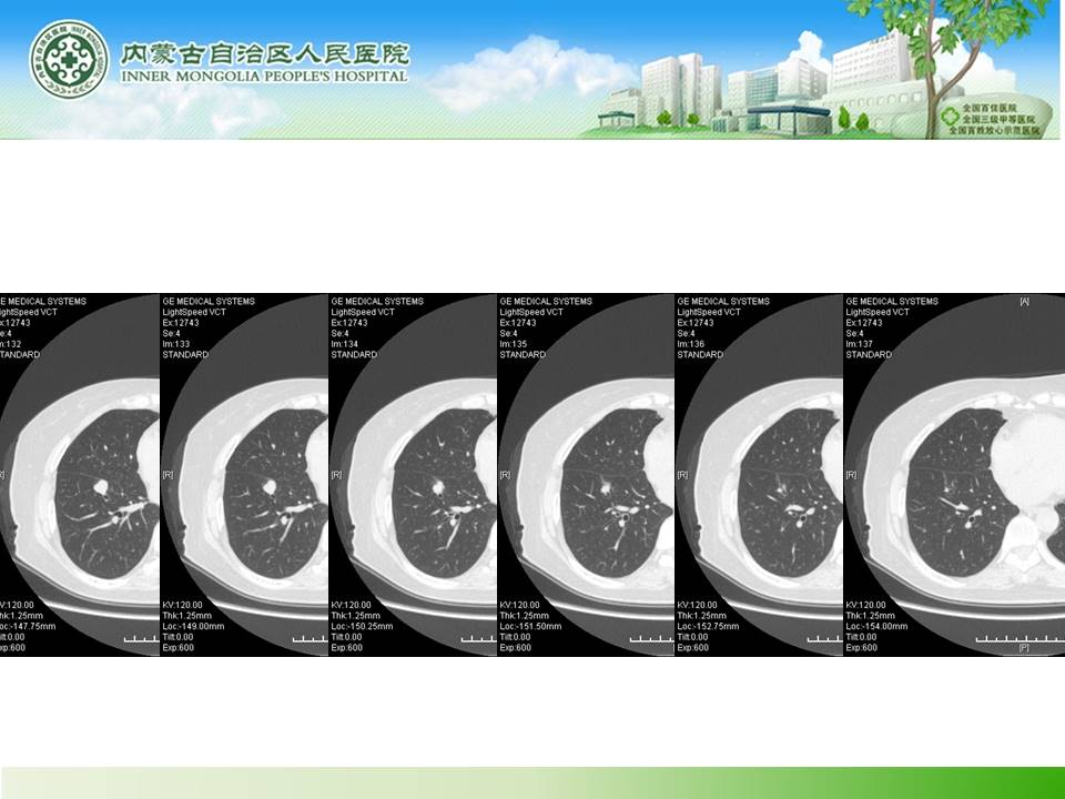 【病例】右肺下叶硬化性血管瘤1例CT