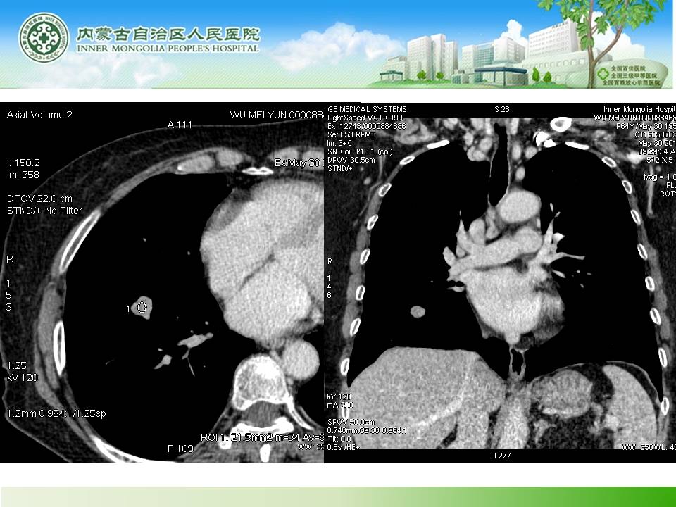 【病例】右肺下叶硬化性血管瘤1例CT
