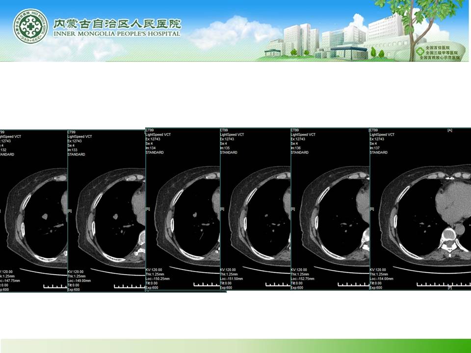 【病例】右肺下叶硬化性血管瘤1例CT