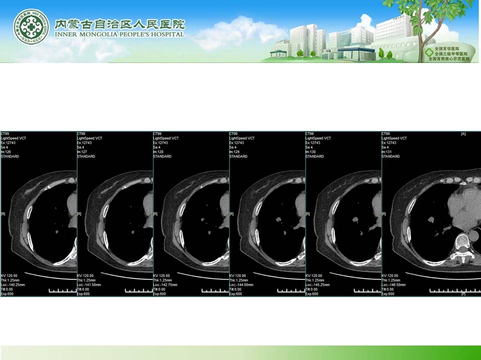 【病例】右肺下叶硬化性血管瘤1例CT