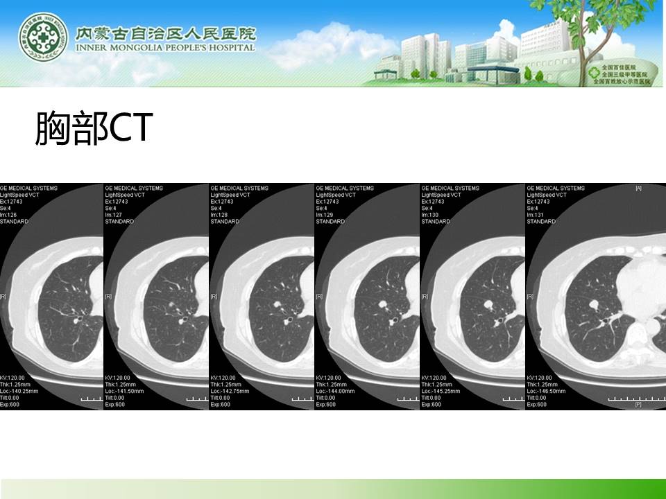 【病例】右肺下叶硬化性血管瘤1例CT