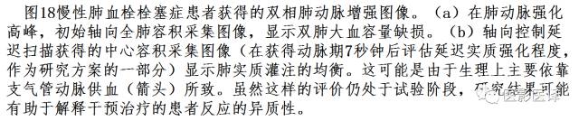 肺动脉高压的双能CT影像：挑战与机遇