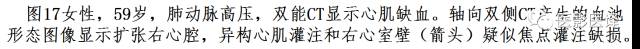 肺动脉高压的双能CT影像：挑战与机遇