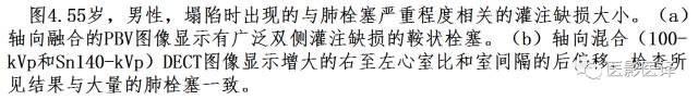 肺动脉高压的双能CT影像：挑战与机遇