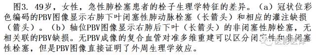 肺动脉高压的双能CT影像：挑战与机遇