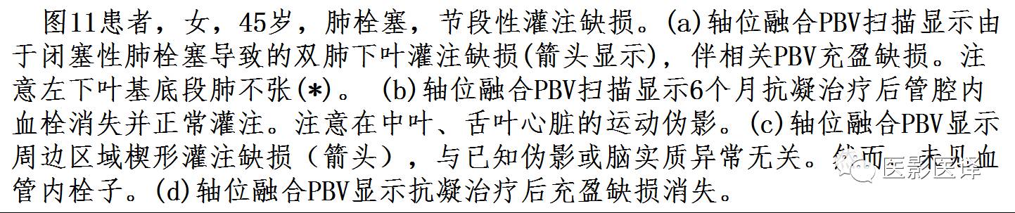 肺动脉高压的双能CT影像：挑战与机遇