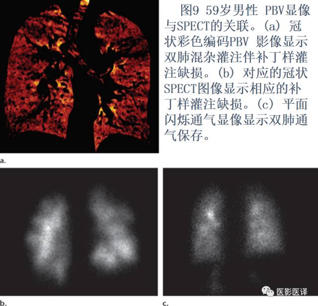 肺动脉高压的双能CT影像：挑战与机遇