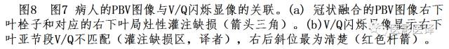 肺动脉高压的双能CT影像:挑战与机遇 肺动脉高压的双能CT影像:挑战与机遇