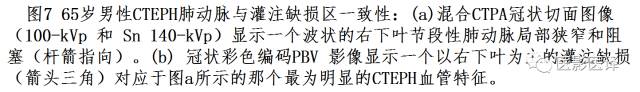 肺动脉高压的双能CT影像：挑战与机遇